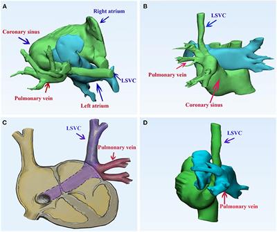 Case Report: Double-Decker Repair of Partial Pulmonary Venous Return Into the Coronary Sinus